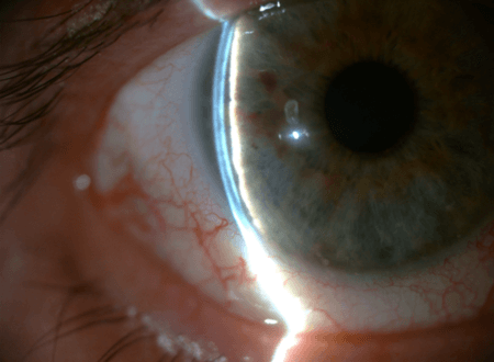 Glaucoma de ângulo estreito