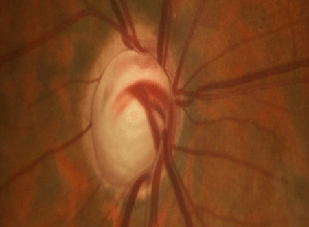Nervo ótico em Glaucoma Avançado