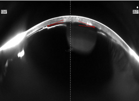 Laser no Glaucoma - Pentacam
